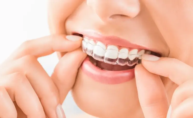 Jak długo trwa leczenie Invisalign?