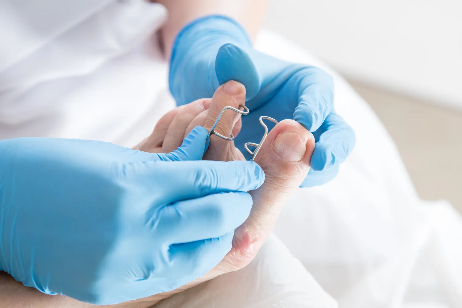  Czemu wrastają paznokcie?