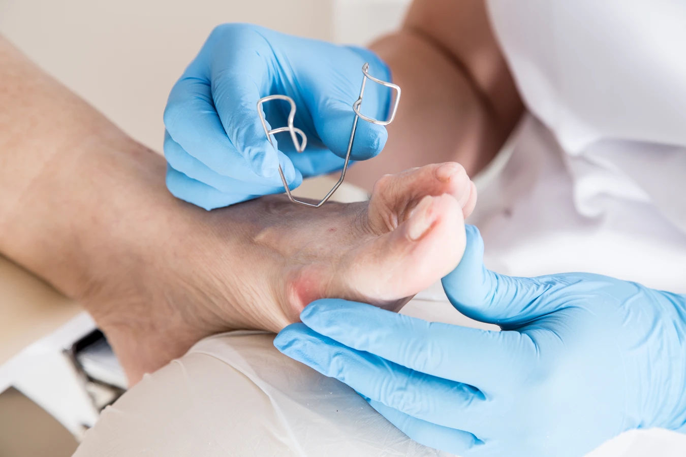 Kurzajki na stopach - nie lekceważ problemu